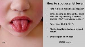 Scarlet Fever Scarlet Fever